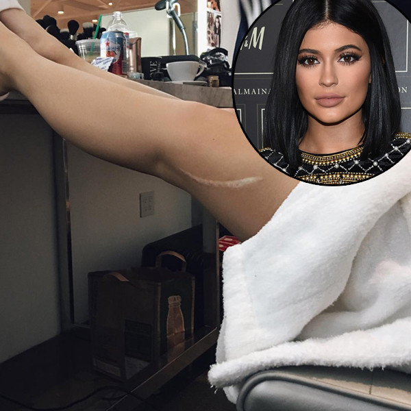 Kylie Jenner Flaunts Huge Leg Scar Is Kendall to Blame for It?